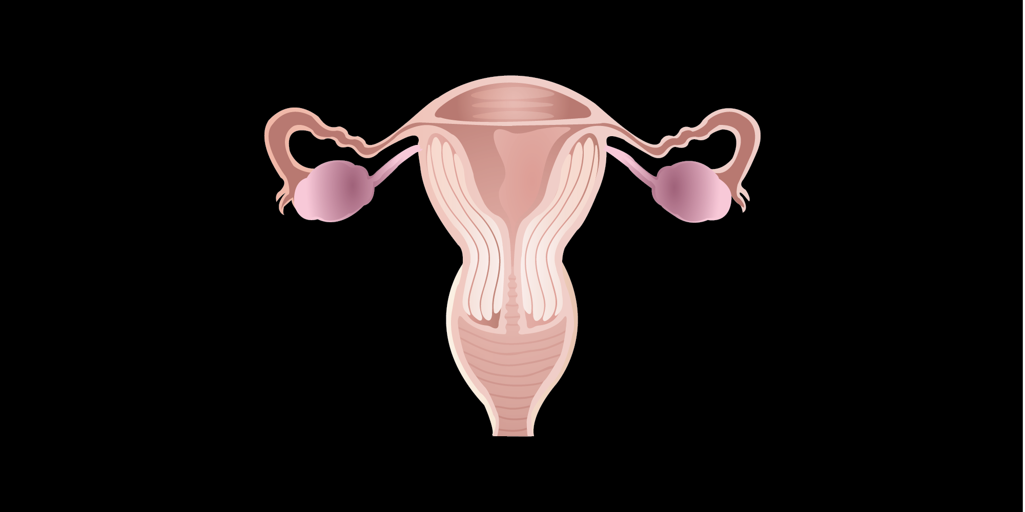 endometriosis-is-associated-with-infertility-due-to-several-factors