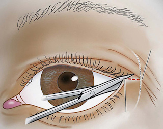 Ocular Trauma 1: Lid Lacerations and Orbital Compartment Syndrome