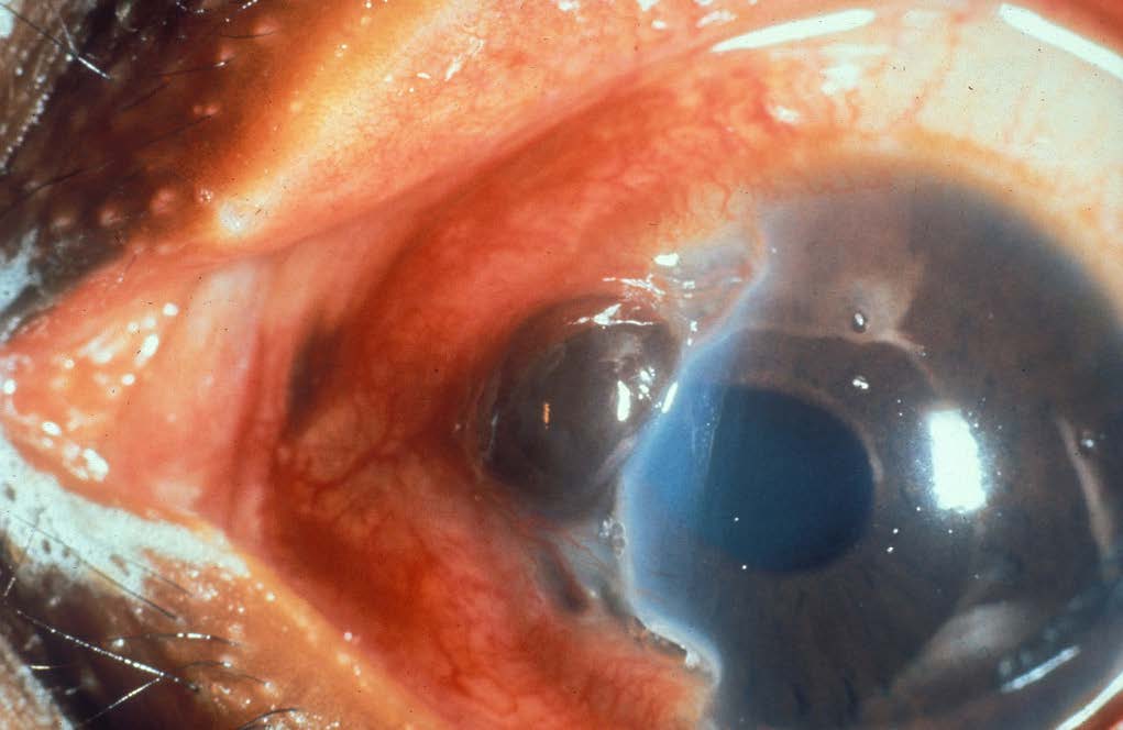 Ocular Trauma 2: Intraocular Foreign Bodies and Globe Rupture